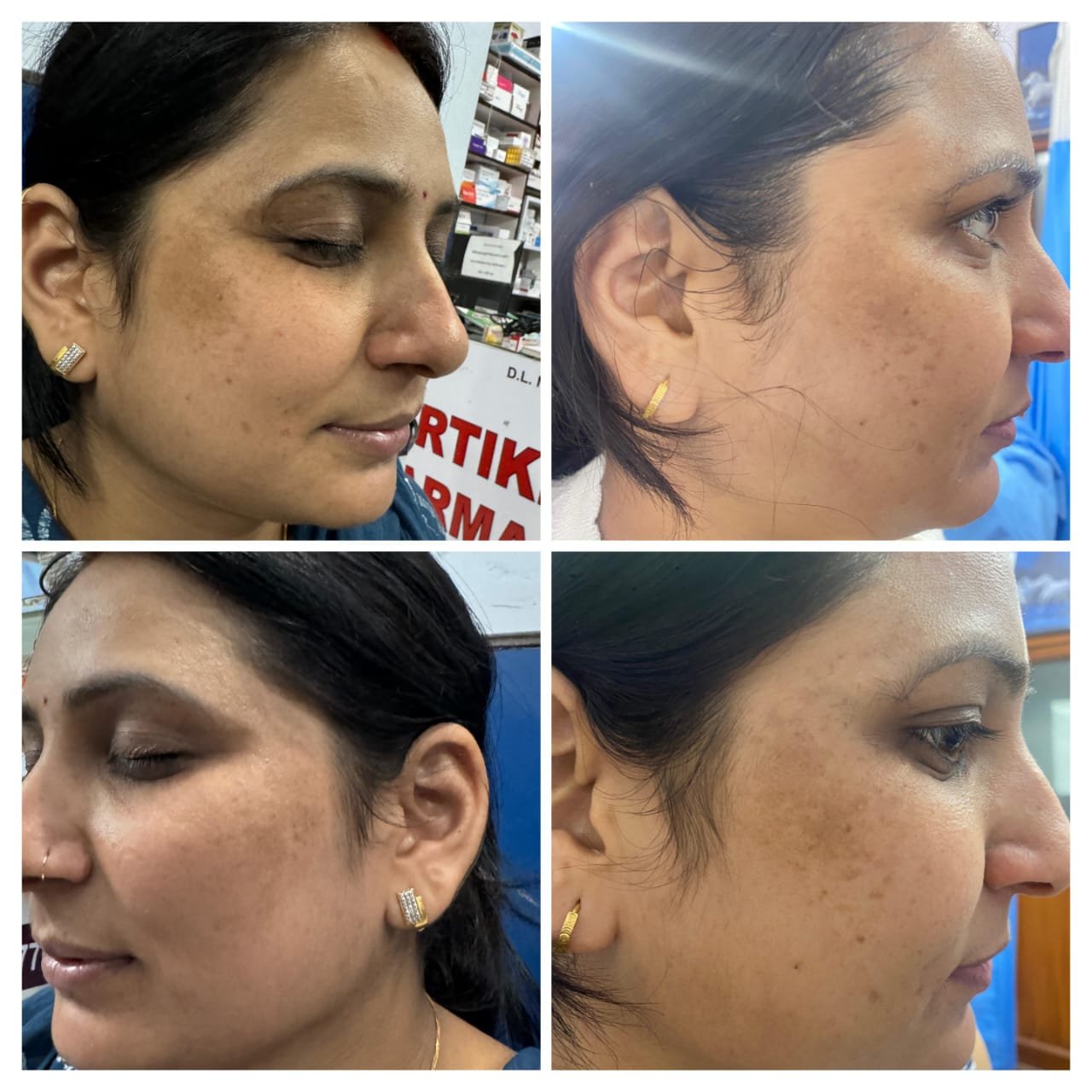 Before and after facial pigmentation treatment showing reduction in dark spots and melasma by Dr. Praveena Agarwal, cosmetic gynaecologist in Bhopal
