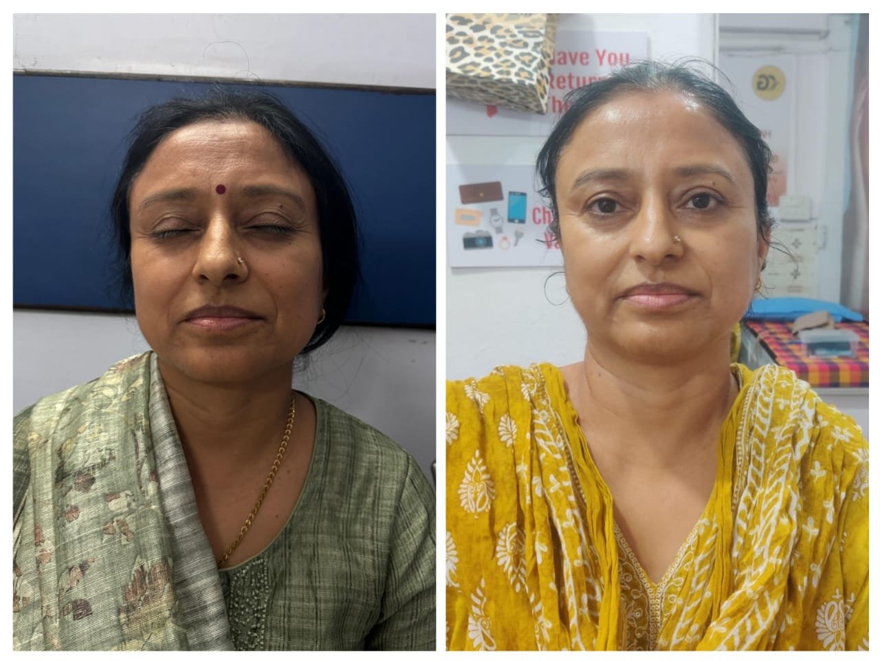 Before and after facial skin improvement showing smoother texture and refreshed appearance by Dr. Praveena Agarwal, cosmetic gynaecologist in Bhopal