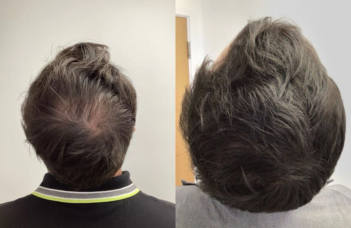Before and after hair regrowth results showing reduced hair thinning under expert care by Dr. Praveena Agarwal – Cosmetic Gynaecologist in Bhopal
