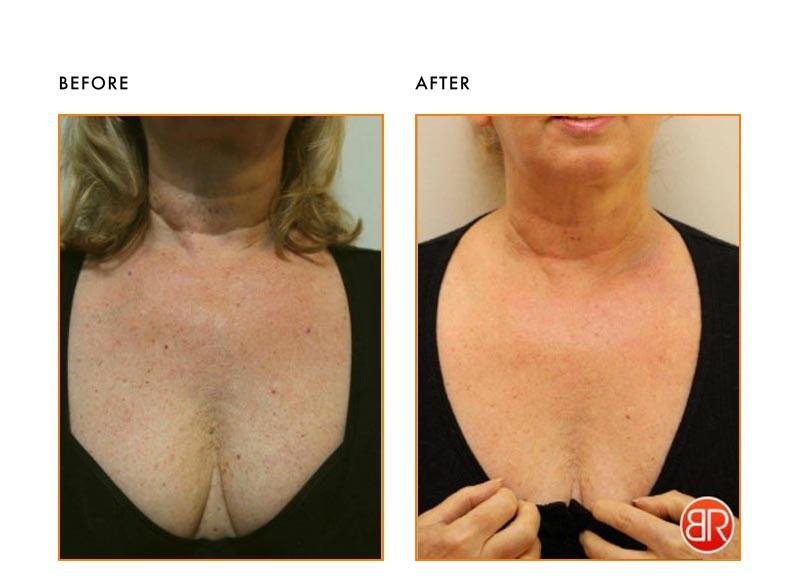 Before and after neck and chest skin rejuvenation results under expert care by Dr. Praveena Agarwal – Cosmetic Gynaecologist in Bhopal