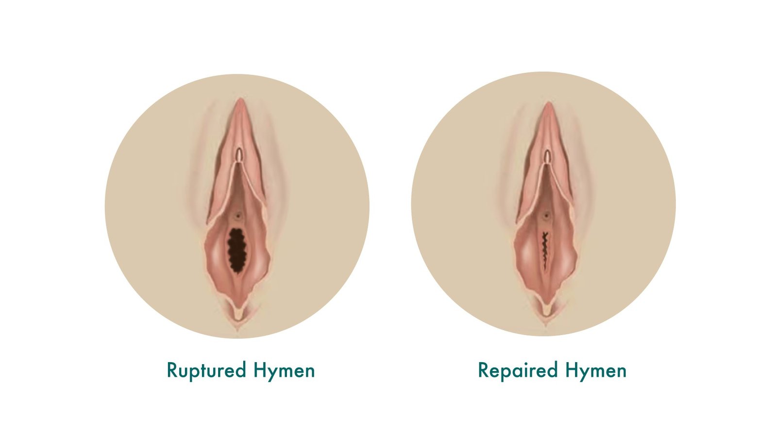 Medical illustration showing ruptured and repaired hymen as part of hymenoplasty treatment by Dr. Praveena Agarwal, cosmetic gynaecologist in Bhopal