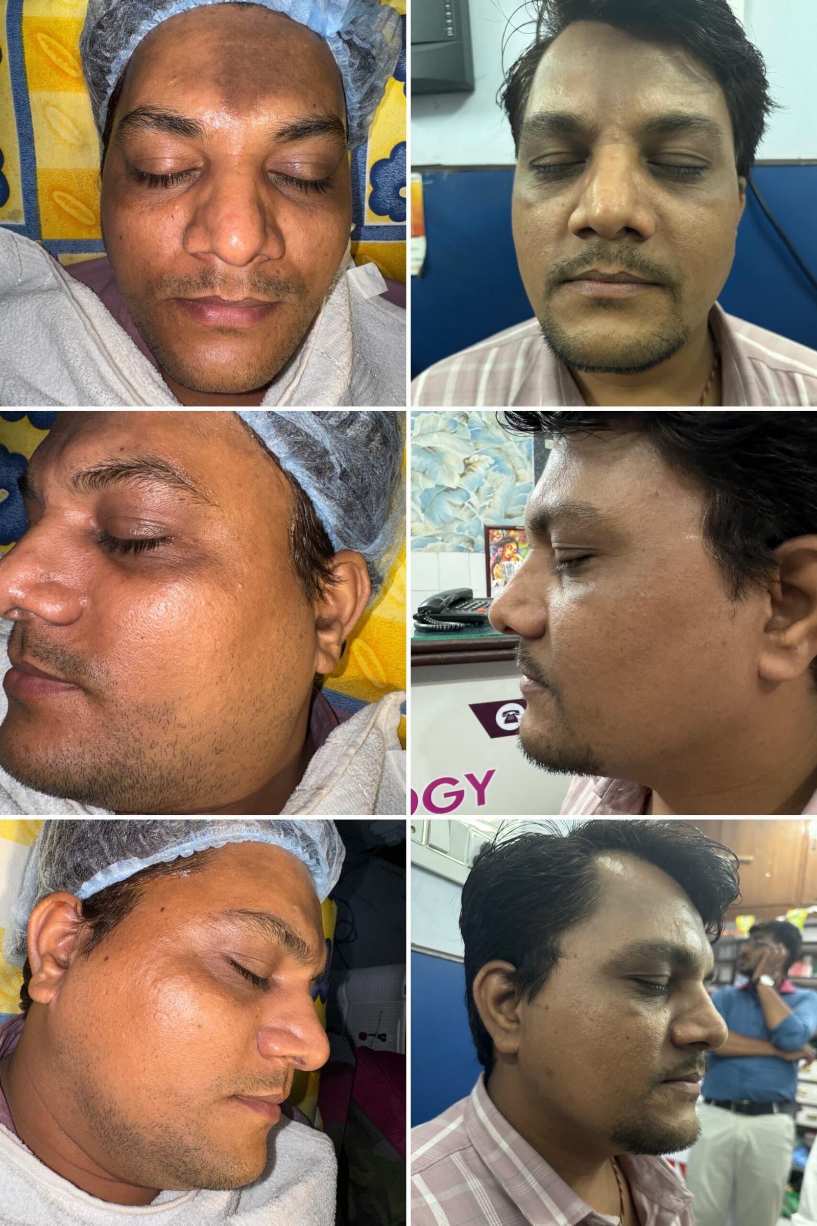 Before and after results of wrinkles removal treatment in Bhopal by Dr. Praveena Agarwal, cosmetic gynaecologist
