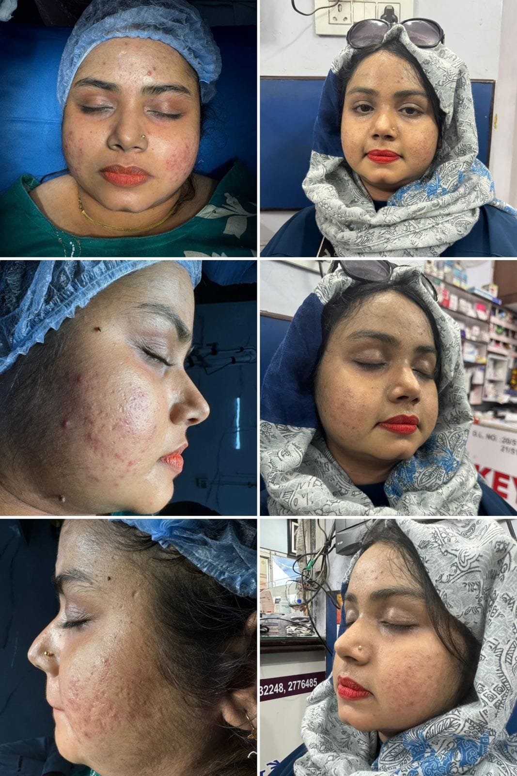 Before and after results of wrinkles removal treatment by Dr. Praveena Agarwal, cosmetic gynaecologist in Bhopal