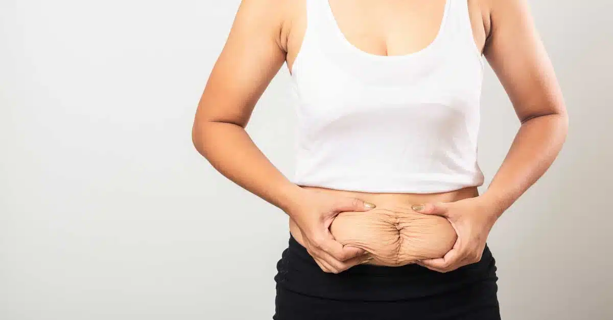 Mommy Makeover by HIFU treatment by Dr. Praveena Agarwal, Cosmetic Gynaecologist in Bhopal