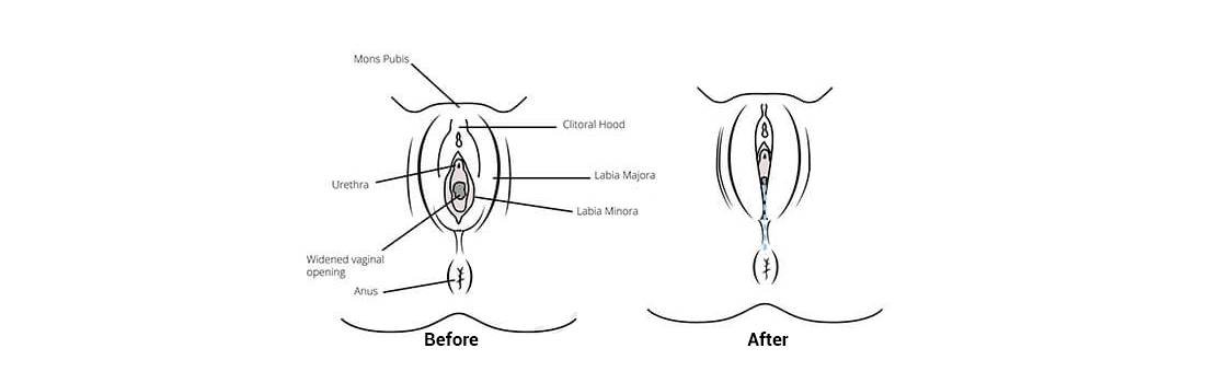 Before and after diagram of hymenoplasty treatment by Dr. Praveena Agarwal, cosmetic gynaecologist in Bhopal
