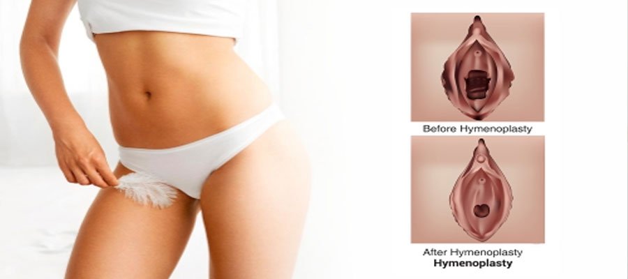Hymenoplasty treatment procedure illustration by Dr. Praveena Agarwal, cosmetic gynaecologist in Bhopal