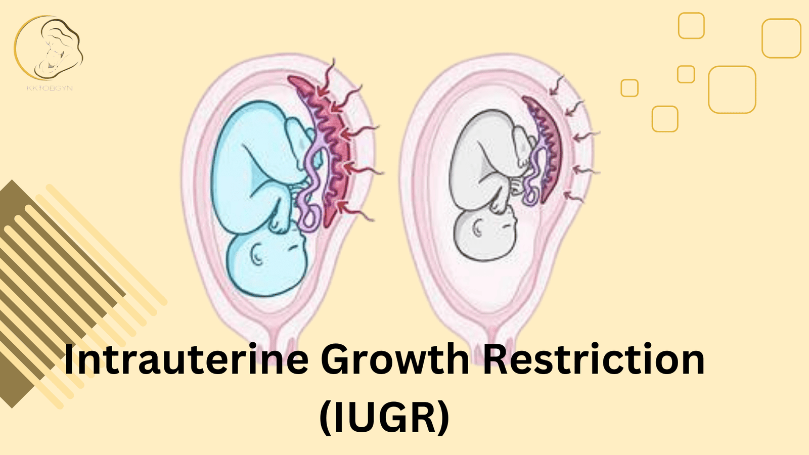 Illustration showing intrauterine growth restriction (IUGR) and fetal development managed with IUGR treatment by Dr. Praveena Agarwal, Cosmetic Gynaecologist in Bhopal