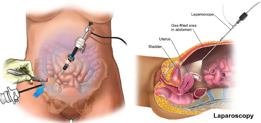 Laparoscopic surgery procedure by Dr. Praveena Agarwal, Cosmetic Gynaecologist in Bhopal