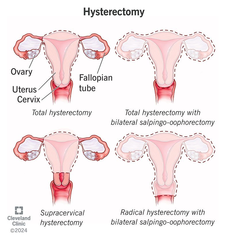 Medical illustration showing different types of hysterectomy treatment including total, supracervical, and radical hysterectomy by Dr. Praveena Agarwal, Cosmetic Gynaecologist in Bhopal