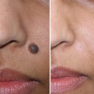 Before and after mole removal treatment by Dr. Praveena Agarwal, Cosmetic Gynaecologist in Bhopal