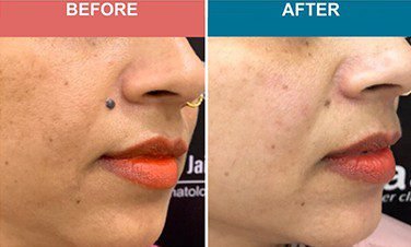 Before and after mole removal results by Dr. Praveena Agarwal, Cosmetic Gynaecologist in Bhopal