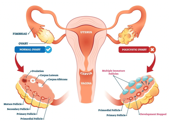 PCOD and PCOS comparison showing normal ovary vs polycystic ovary treated by Dr. Praveena Agarwal, Cosmetic Gynaecologist in Bhopal