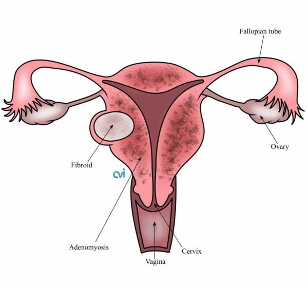 Adenomyosis treatment explained by Dr. Praveena Agarwal, Cosmetic Gynaecologist in Bhopal
