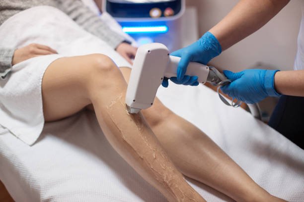 Laser hair reduction treatment on legs performed by Dr. Praveena Agarwal, Cosmetic Gynaecologist in Bhopal
