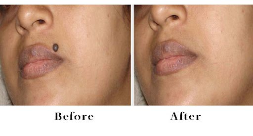 Before and after mole removal treatment by Dr. Praveena Agarwal, Cosmetic Gynaecologist in Bhopal