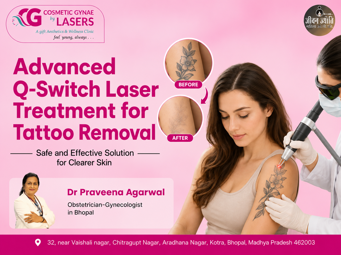 Advanced Q-Switch Laser Treatment for Tattoo Removal: Safe and Effective Solution for Clearer Skin