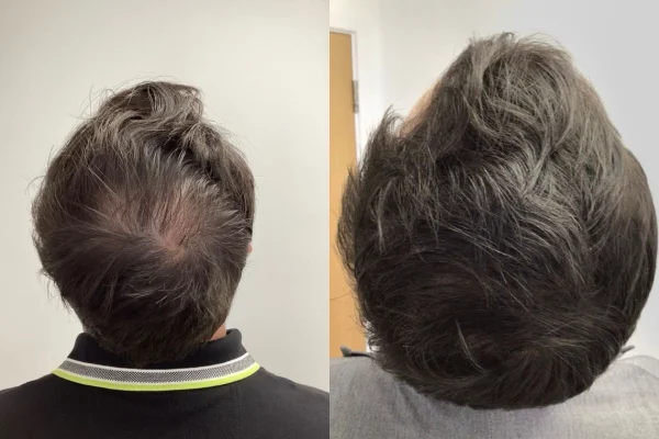 Before and after hair regrowth results showing reduced hair thinning under expert care by Dr. Praveena Agarwal – Cosmetic Gynaecologist in Bhopal