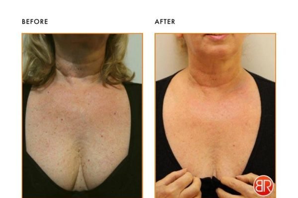 Before and after neck and chest skin rejuvenation results under expert care by Dr. Praveena Agarwal – Cosmetic Gynaecologist in Bhopal